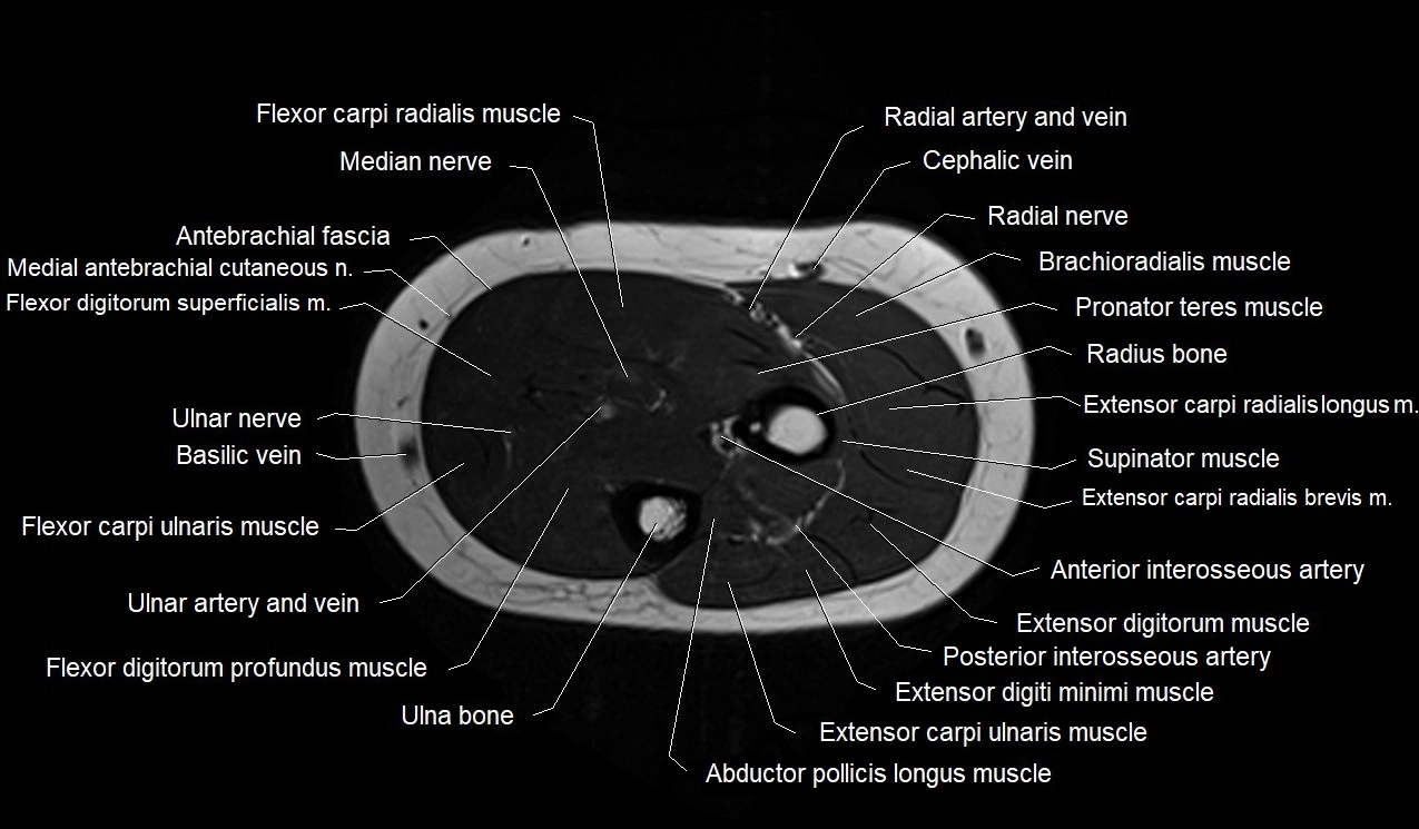 MRI 3T forearm axial cross sectional anatomy image 19.webp